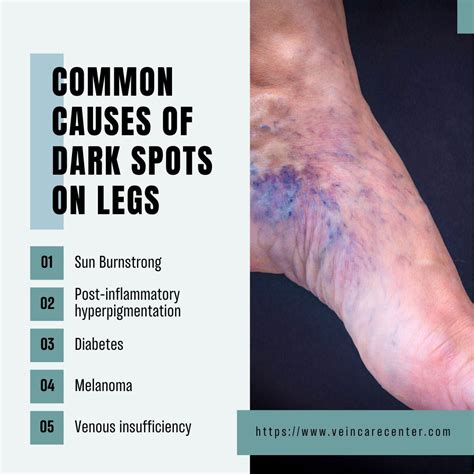 dark spots on legs causes